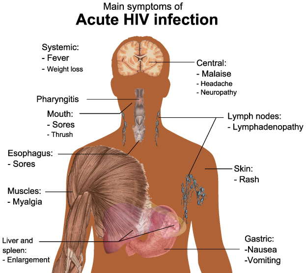 Diagramm eines menschlichen Körpers mit "Akute HIV-Infektion" beschriftet, das die mit der Erkrankung verbundenen Hauptsymptome hervorhebt.