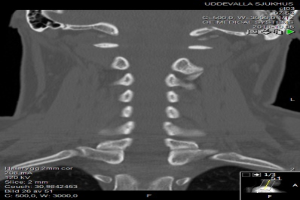 Eine MRT-Aufnahme des Halses eines Mannes mit einem Bruch, die auf einem Computerbildschirm angezeigt wird, zeigt die Größe, Form und Lage des Bruchs.